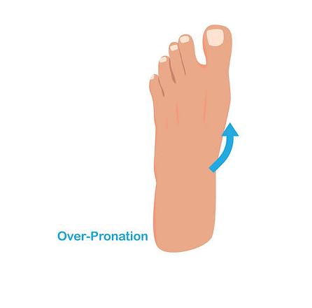 diagram of foot showing over-pronation