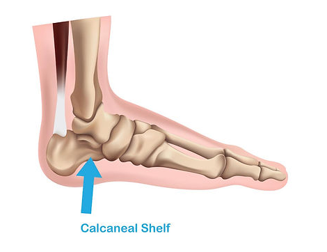 diagram of foot showing calcaneal shelf