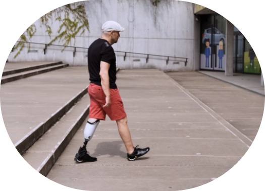 man walking with a prosthetic limb